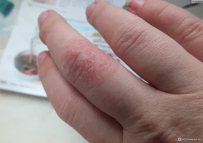 Изображение дерматита на руках для использования в медицинских целях