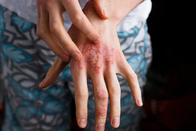 Картинка дерматита на руках в WebP