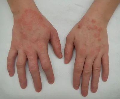 Фотография рук с дерматитом в формате PNG для диагностики