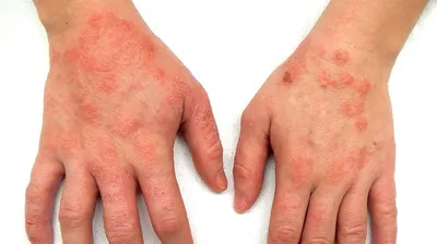 Картинка дерматита на руках для использования в рекламных целях