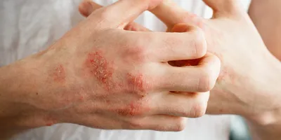 Картинка дерматита на руках для использования в брошюрах