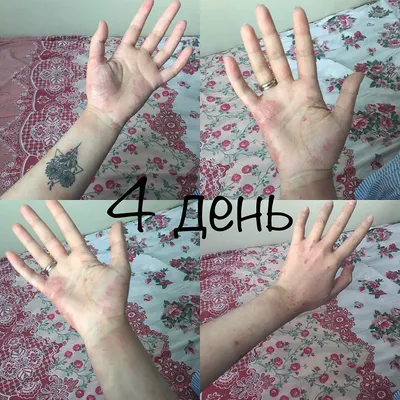 Фотография рук с дерматитом с разными уровнями воспаления
