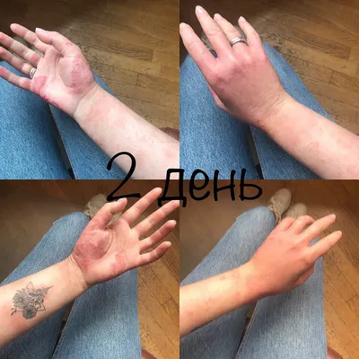 Фото дерматита на руках с разными фонами