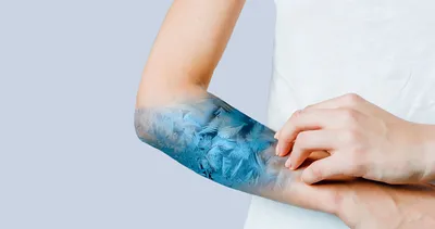 Картинка дерматита на руках для использования в медицинских журналах
