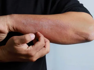 Изображение дерматита на руках в низком разрешении