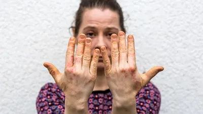 Фото рук с развитым дерматитом