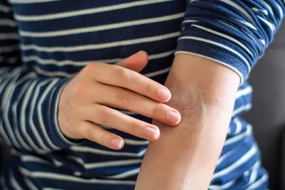 Картинка дерматита на руках с указанием стадии развития
