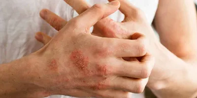 Фото дерматита на руках в формате WebP