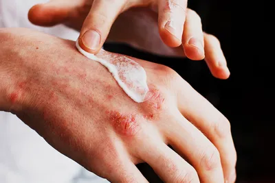 Фотография рук с начальной стадией дерматита