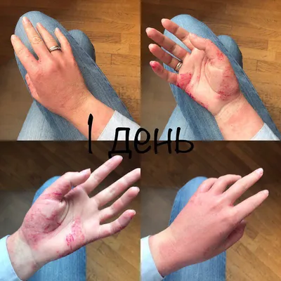 Фотография рук с дерматитом в JPG