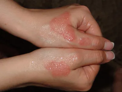Изображение дерматита на руках в формате PNG