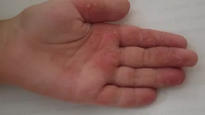 Изображение дерматита на руках в высоком разрешении