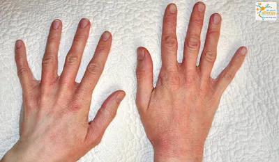Картинка рук с кожными высыпаниями от дерматита