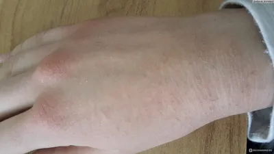 Фотография дерматита на руках в формате JPG