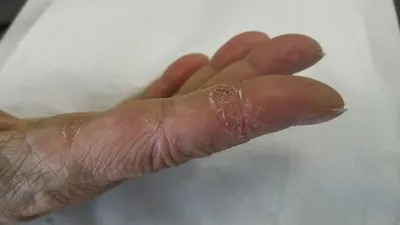 Картинка дерматита на руках с описанием симптомов