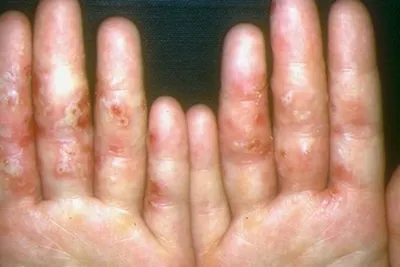 Фото сыпи на кистях рук от дерматита