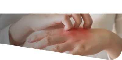 Изображение кожных высыпаний на руках при дерматите