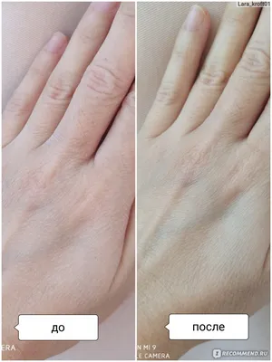 Изображение дерматита на руках с рекомендациями по уходу за кожей
