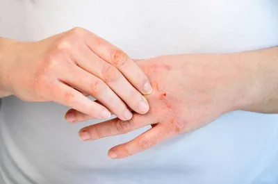 Фото рук с явлениями дерматита на фоне