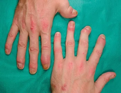 Изображение покраснения кожи на руках от дерматита