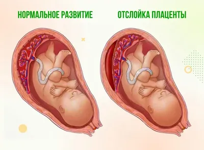 Низкое расположение плаценты при беременности – симптомы, причины,  признаки, диагностика и лечение