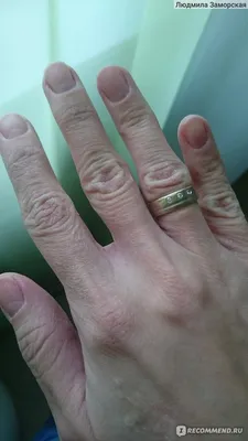 Руки с диатезом: фотография в высоком разрешении