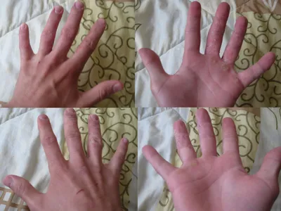 Дисгидротическая экзема на пальцах рук фотографии