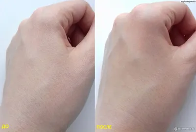 Фото дисгидроза кистей рук: как уберечься от этого заболевания