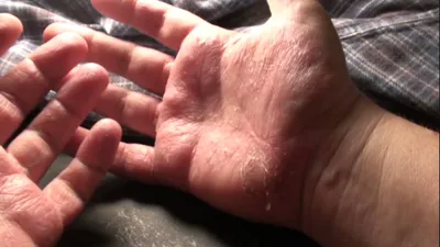Фотография дисгидроза кистей рук: как лечить заболевание дома