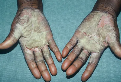 Фото дисгидроза кистей рук: какие факторы могут спровоцировать заболевание