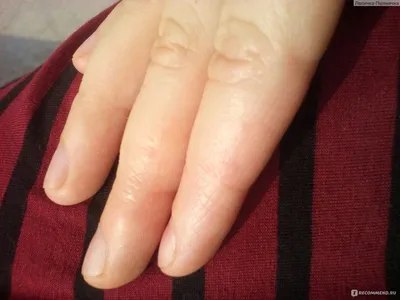 Изображение Дисгидроз кистей рук: наблюдение за болезнью