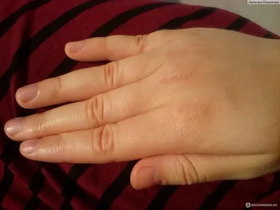 Изображение дисгидроза пальцев рук для лечения