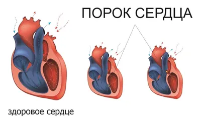 У тебя же дырка в сердце!» – врачи не знали, как лечить Аню | Правмир