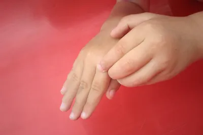 Фото экземы на пальцах: лучшие методы лечения