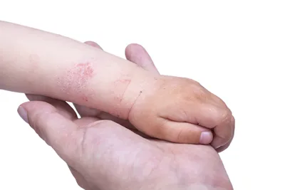 Фотка экземы на руках: как правильно ухаживать за кожей