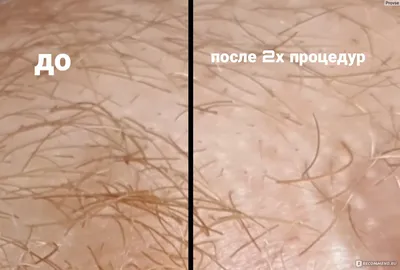 Электроэпиляция ног в Москве, цены, сделать удаление волос током на ногах в  салоне