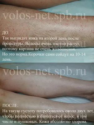 Электроэпиляция в Казани: лица, ног, зоны бикини – узнать цены | Клиника  МЕДЕЛ