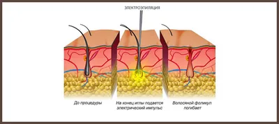 Электроэпиляция или лазерная эпиляция что лучше? - сравнение, отличия,  отзывы