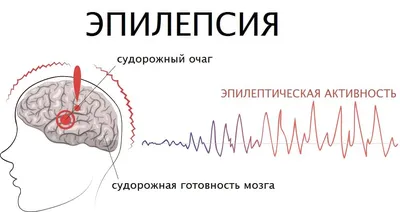 Эпилепсия у взрослых: причины, диагностика, лечение - Доктор Позвонков