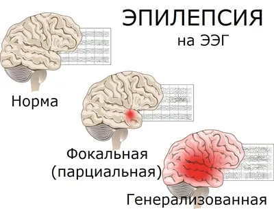 Картинки на тему #эпилепсия - в Шедевруме