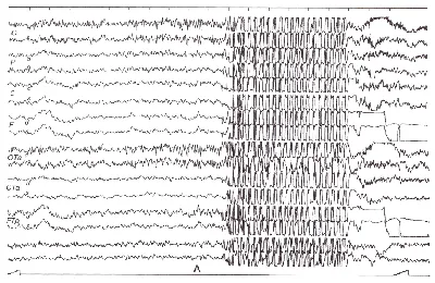 Эпилепсия. Приступ эпилепсии — его причины, признаки и симптомы.