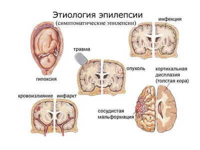 Что такое эпилепсия: причины, симптомы, лечение - Медицинский Центр на  Ботанической