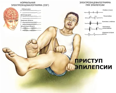 Медицинский Фон Мозга Эпилепсия — стоковые фотографии и другие картинки  Эпилепсия - Эпилепсия, Взрослый, 2015 - iStock