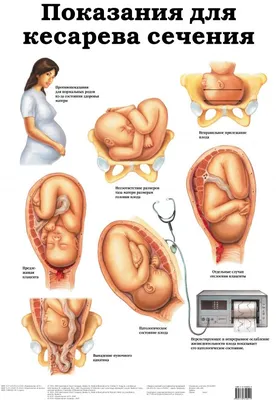 Показания для кесарева сечения. ВИЧ и СПИД | Кесарево сечение, Йога для  беременных, Этапы беременности