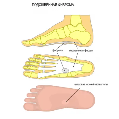 Картинка фибромы на руке