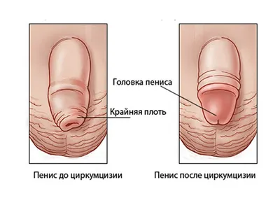 ᐈ Лечение фимоза 【Левый Берег】 Киев ~ Цены