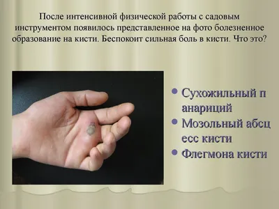 Фото с примером флегмоны кисти руки: диагностика и лечение