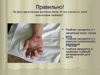 Изображение флегмоны кисти руки: детали болезни