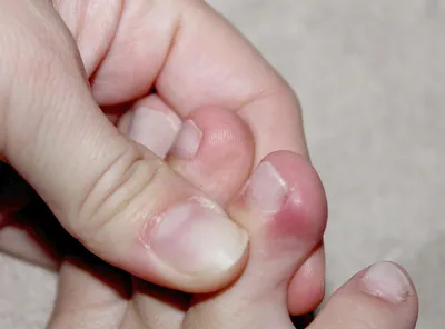 Редкое фото флегмоны кисти руки: как выглядит болезнь