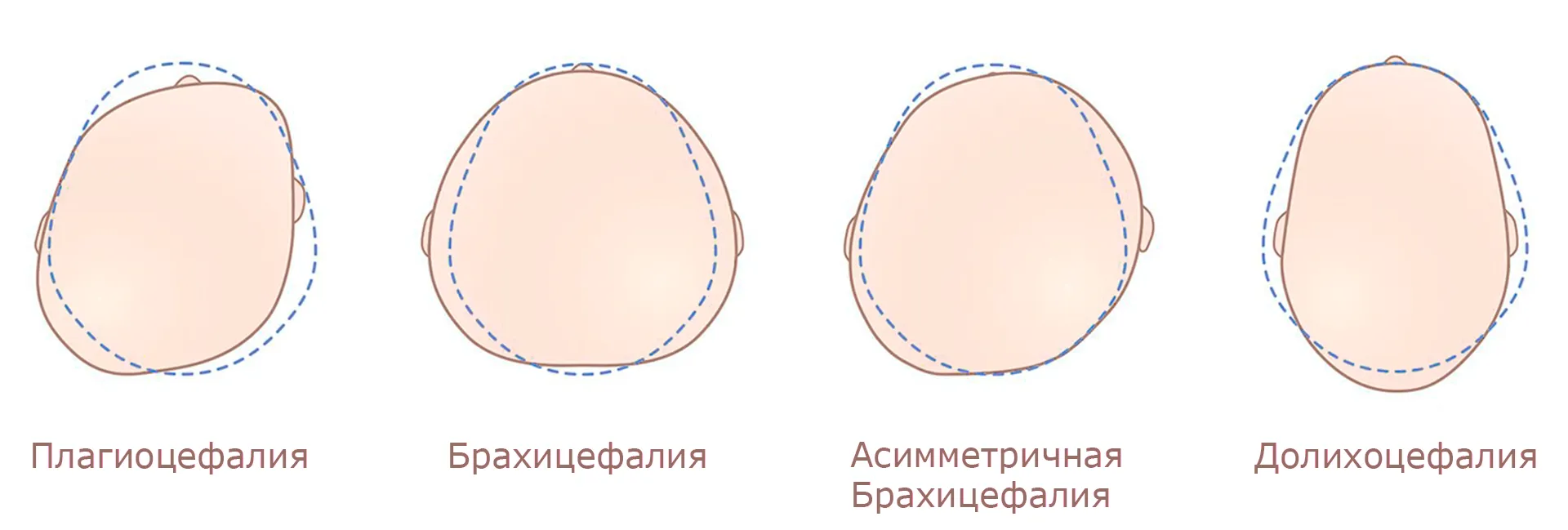 Форма головы у новорожденных